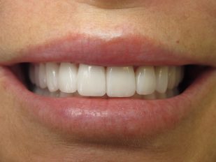 patient 37 after