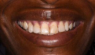 patient 13 before