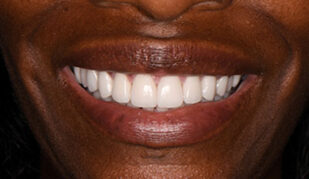 patient 13 after