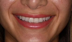 patient 11 before