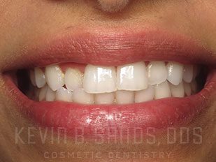 patient 61 before