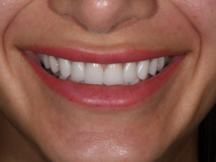 patient 13 after