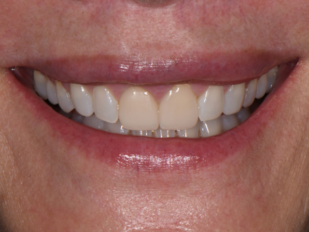 patient 14 before