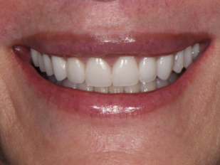 patient 14 after