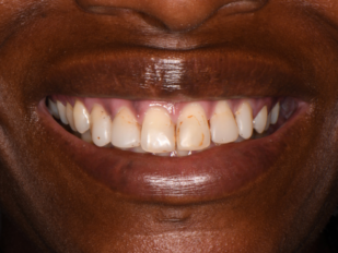 patient 15 before